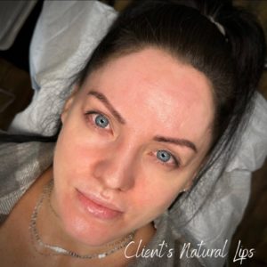 Client's natural lips
