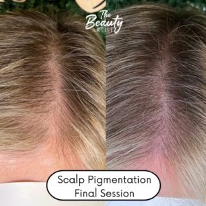 Example of scalp pigmentation final session