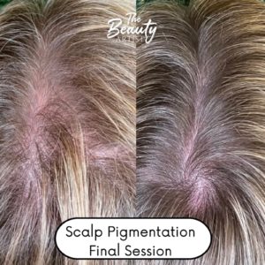 Example of scalp pigmentation final session