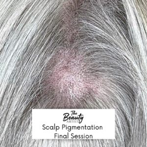 Example of scalp pigmentation final session