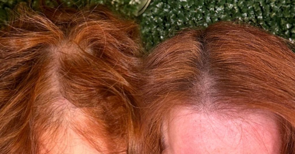 Before and after scalp pigmentation